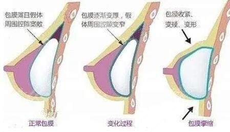 毛面假體和光面假體哪個好?