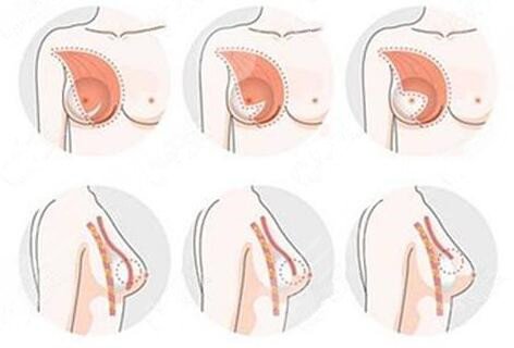 假體隆胸手術術前要準備什么?