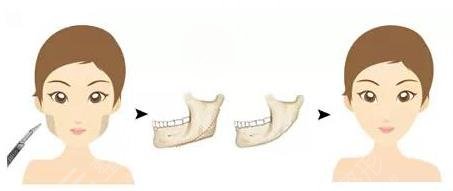 下頜角整容手術(shù)