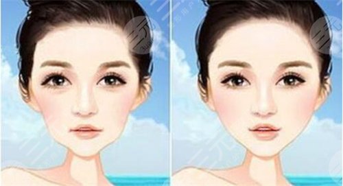 真人體驗(yàn)熱拉提術(shù)后2個(gè)月