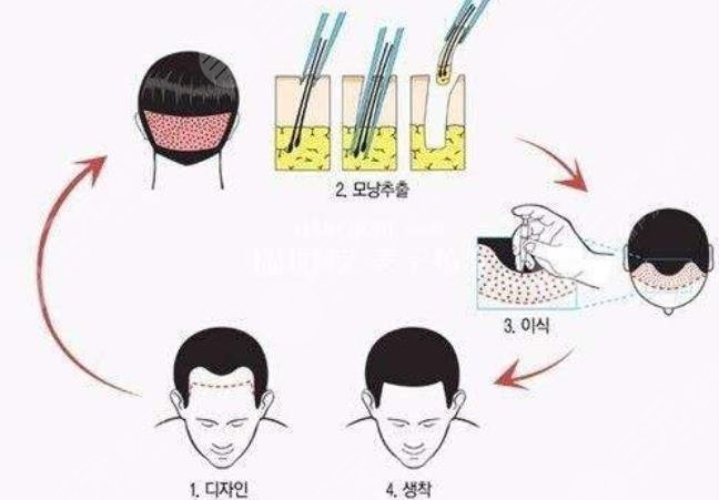 微針植發(fā)技術(shù)