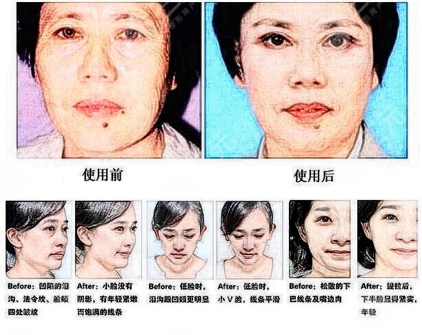 玻尿酸填充法令紋真實案例果圖:術(shù)前一天