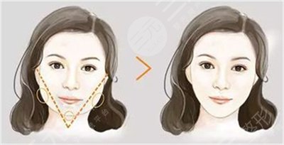 一針瘦臉瘦咬肌能維持多久