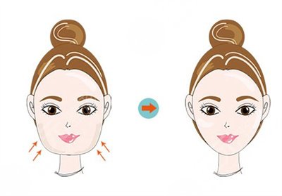 一針瘦臉瘦咬肌能維持多久