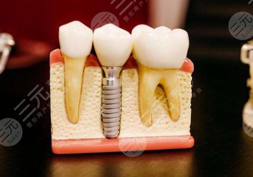 2022全國種植牙價格表種植牙的價格表，品牌、醫(yī)生、規(guī)模影響價格