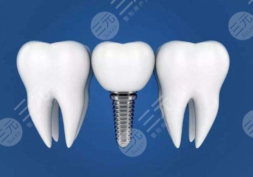 種植牙價格的影響因素