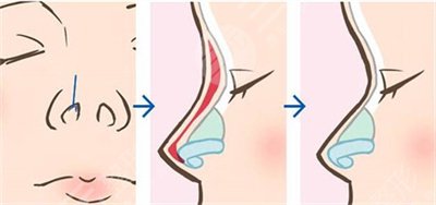 自體軟骨隆鼻術后注意事項