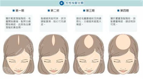 上海劍橋醫(yī)院植發(fā)怎么樣？植發(fā)醫(yī)生名單&植發(fā)案例果對(duì)比圖~