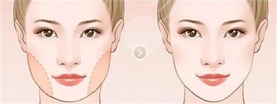 楊子珊整容前后照片