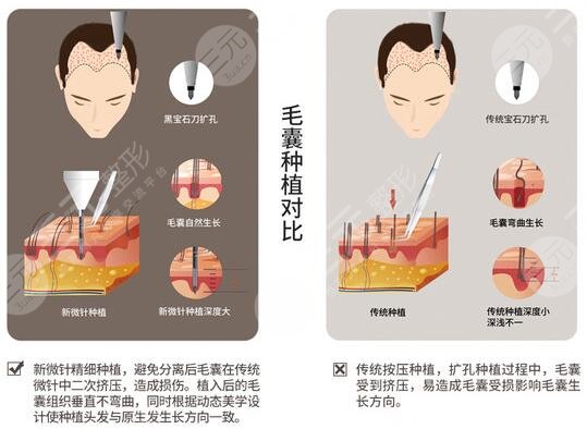 發(fā)際線種植