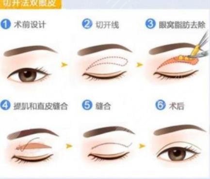 眼部綜合整形是什么意思?