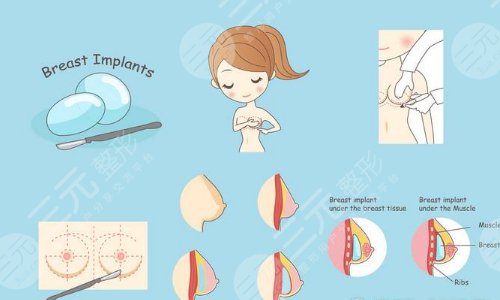 棉花糖隆胸手術原理