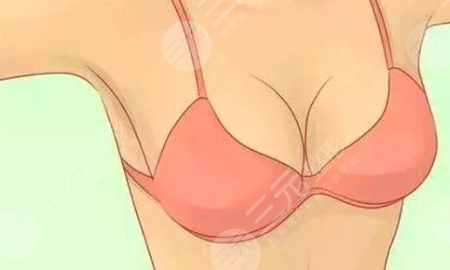 棉花糖隆胸真的不疼嗎？可信嗎？棉花糖隆胸案例術(shù)后：S曲線爆美！