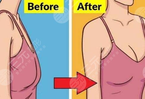 棉花糖隆胸大概需要多少錢?