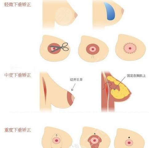 棉花糖隆胸真的不疼嗎？