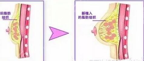 棉花糖隆胸案例果