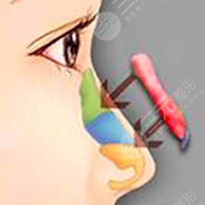 成都駐顏整形果好不好？自體隆鼻變美日記分享