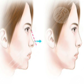 貴陽美貝爾整形口碑如何？誠意分享B****術(shù)后對比