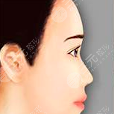 南京華美整形注射美容果好不好？B****術(shù)后果分享
