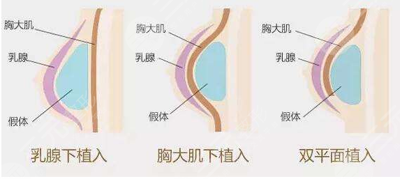 曼托隆胸術(shù)前需準備什么？