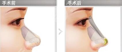濟(jì)南藝星做鼻部手術(shù)案例