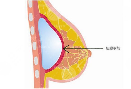 自體脂肪填充豐胸都需要注意什么呢?