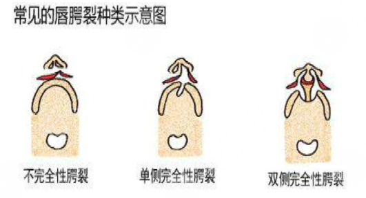 唇腭裂鼻子修復多大年齡合適？唇腭裂修復過程和時間需要多久？