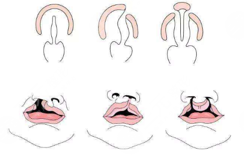 唇腭裂鼻子修復多大年齡合適？
