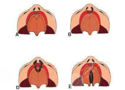 唇腭裂修復過程和時間需要多久？