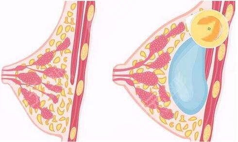 廣州奧美定取出荔灣區(qū)人民醫(yī)院