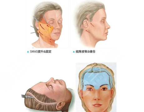 拉皮手術(shù)傷口會不會留疤？疤痕多久消失？手術(shù)注意事項30秒速讀