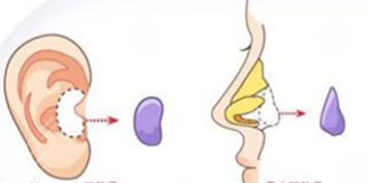 耳軟骨隆鼻術(shù)前準(zhǔn)備工作：