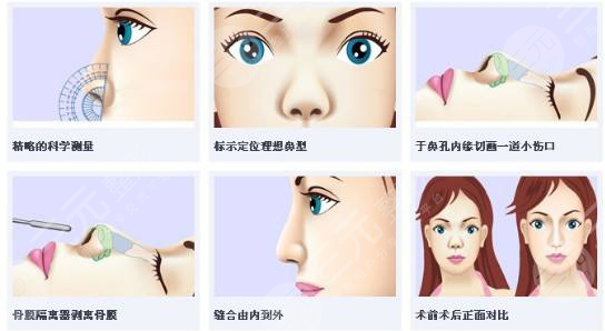 耳軟骨隆鼻術(shù)后護(hù)理知識(shí)：