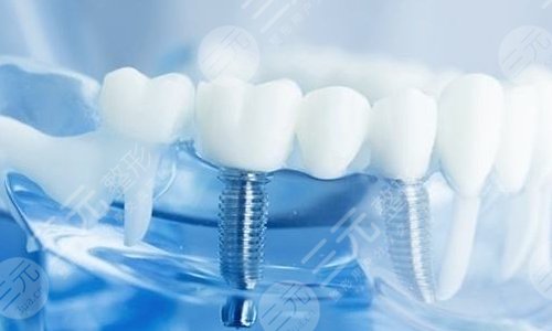 口腔問答一：種植牙壽命是多少年?