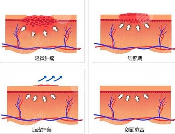 深圳激光去疤痕有嗎?