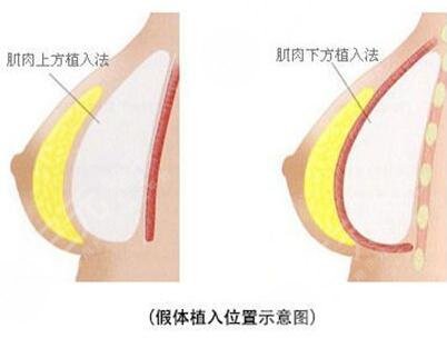 魔滴和曼托怎么選擇？