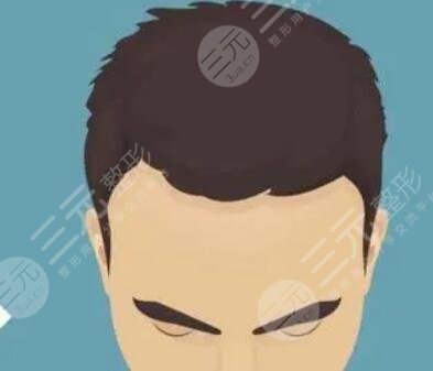 種植頭發(fā)的注意事項(xiàng)