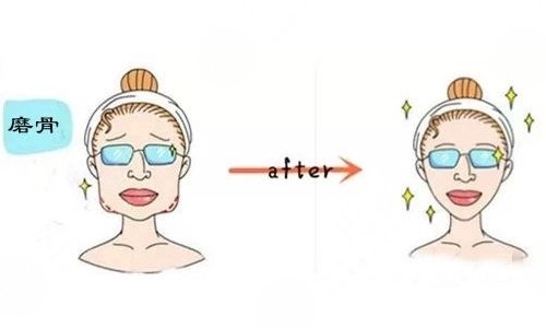 下頜角整形術(shù)有危險(xiǎn)嗎?