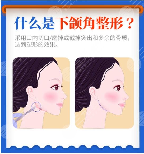 下頜角整形術(shù)有危險(xiǎn)嗎？費(fèi)用大概多少錢？?jī)r(jià)格表附上