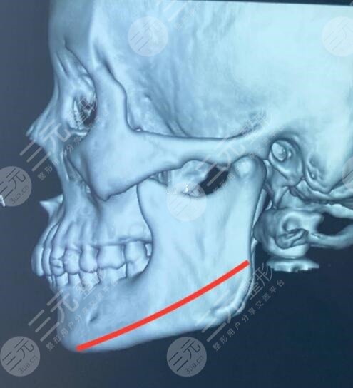 下頜角整形手術(shù)有哪些禁忌人群?
