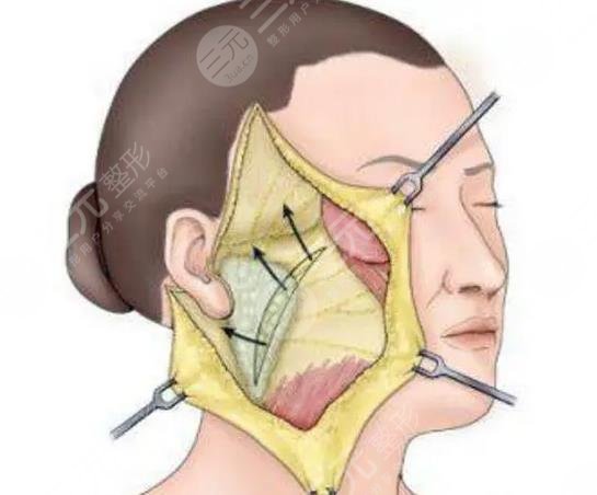 大拉皮手術(shù)15天照片