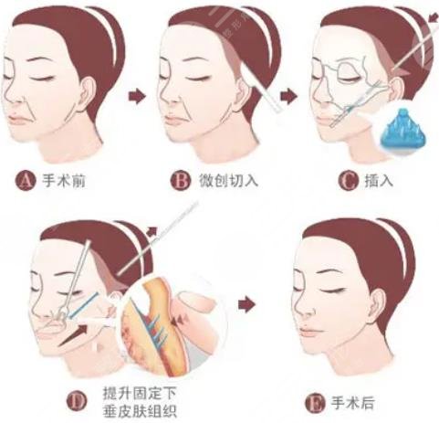 大拉皮手術(shù)15天照片