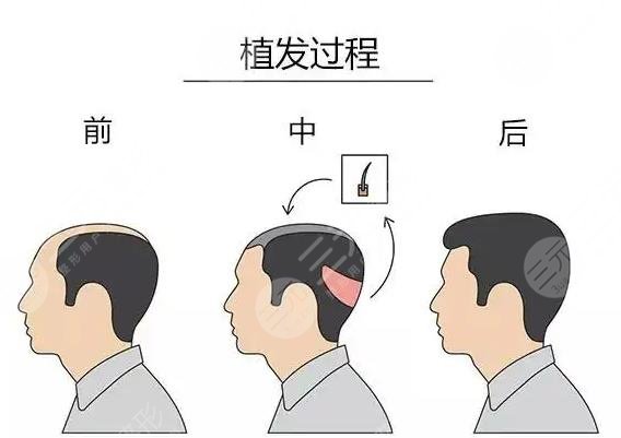 頭發(fā)種植手術(shù)