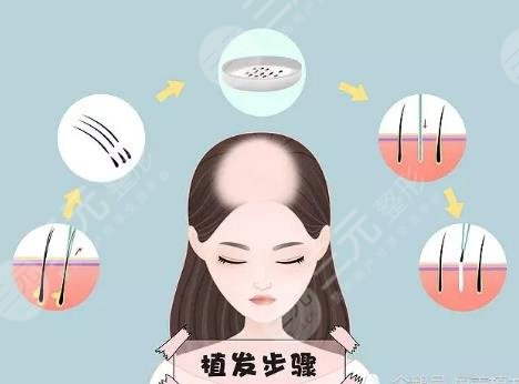 植發(fā)手術(shù)項目科普