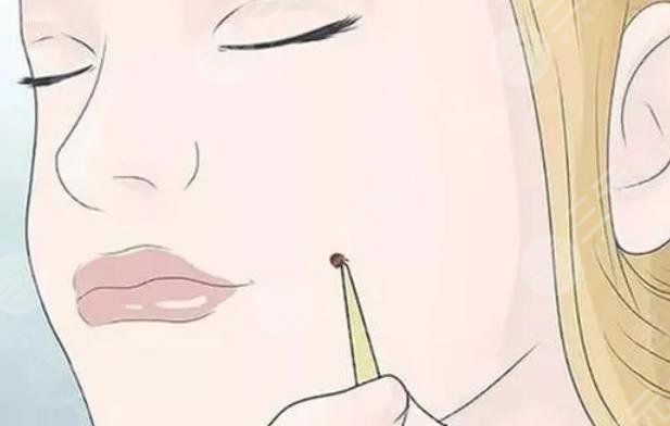 激光臉部點痣1到7天圖片恢復全過程，不再做“痣”女孩~