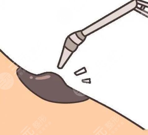 激光臉部點痣1到7天圖片恢復全過程，不再做“痣”女孩~