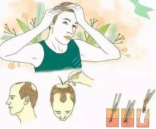 植發(fā)3000個(gè)單位的價(jià)格是多少