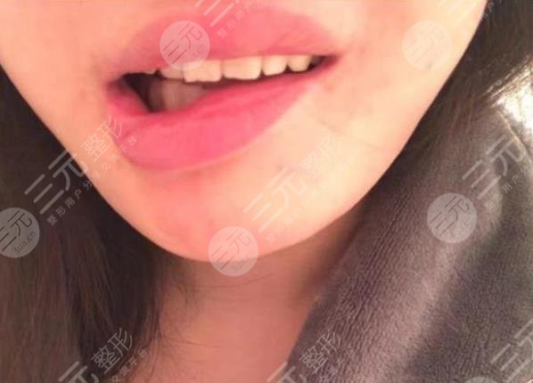 女子整容失敗嘴巴歪，花一年多時間緩解！整形醫(yī)院只退3.5萬手術費！