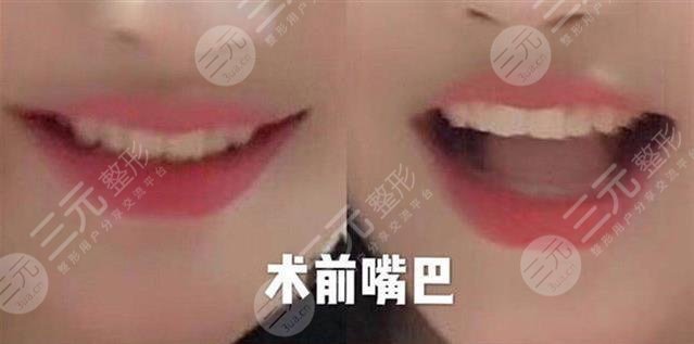 女子整容失敗嘴巴歪是真的嗎?
