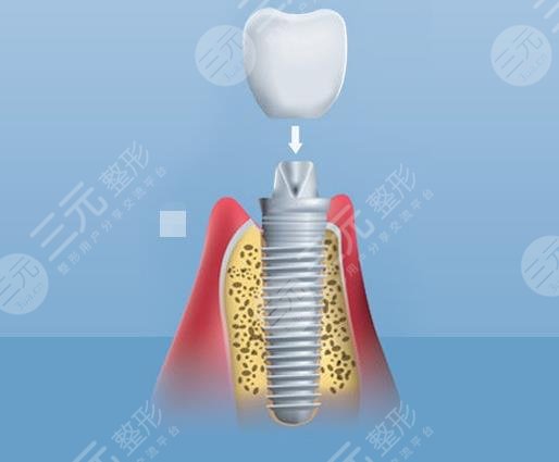 種植牙的術(shù)后注意